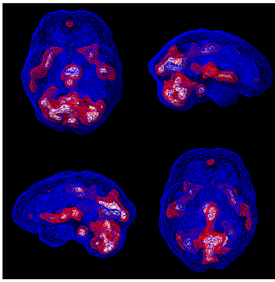 bloodflow spect scan, blue wireframe mesh with red-orange hot spots